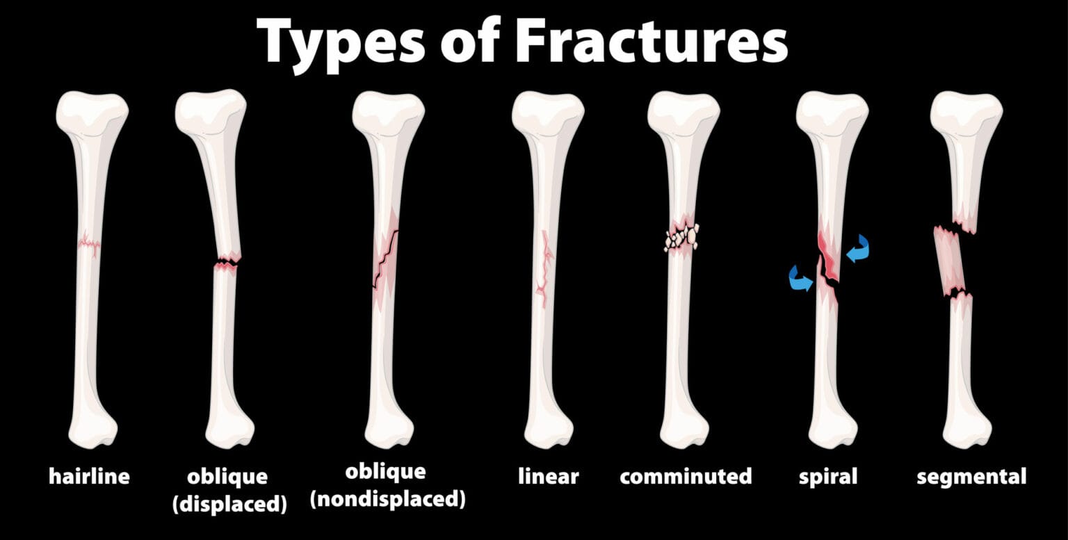 Overcoming Stress From Hairline Fractures Triangle Physiotherapy